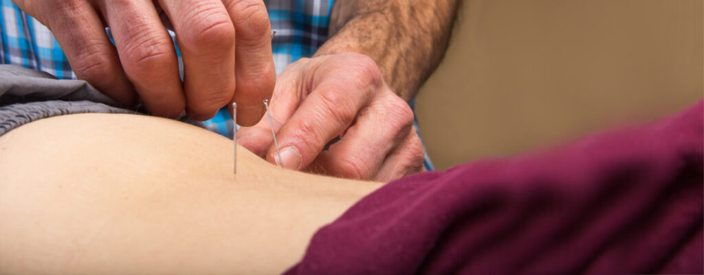 Dry Needling at InSync Wellness