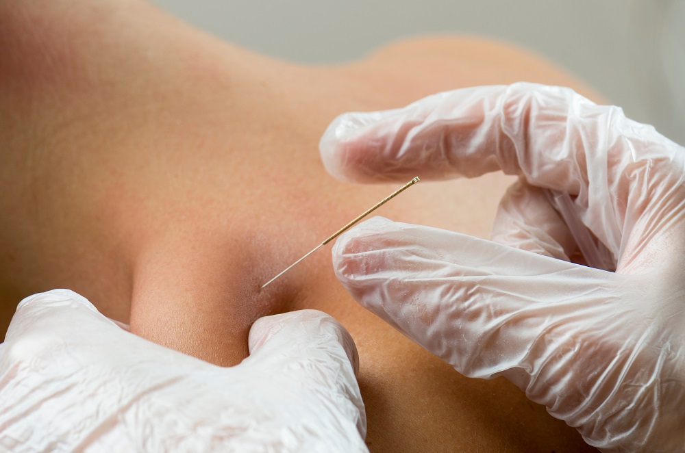 dry needling brampton
